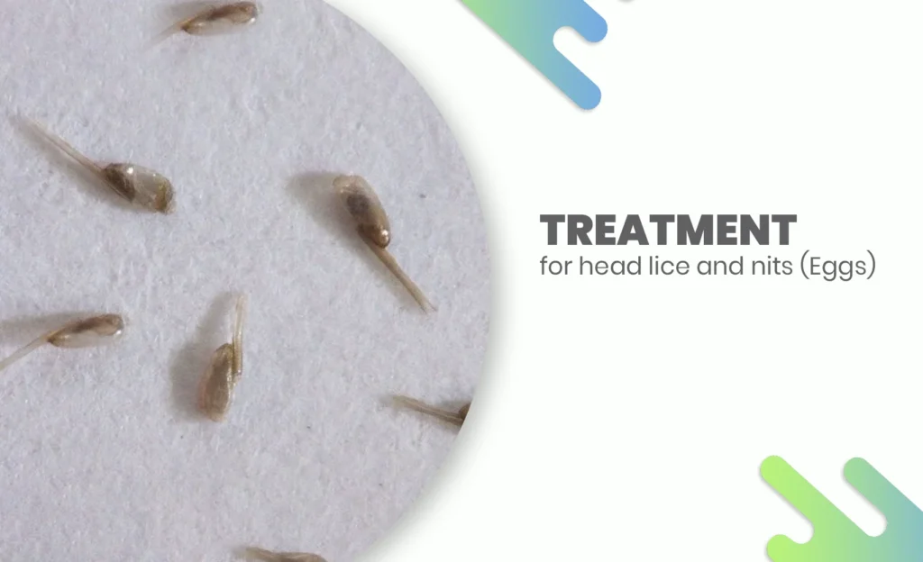 Head lice treatment showing nits (eggs) close-up for lice removal awareness.