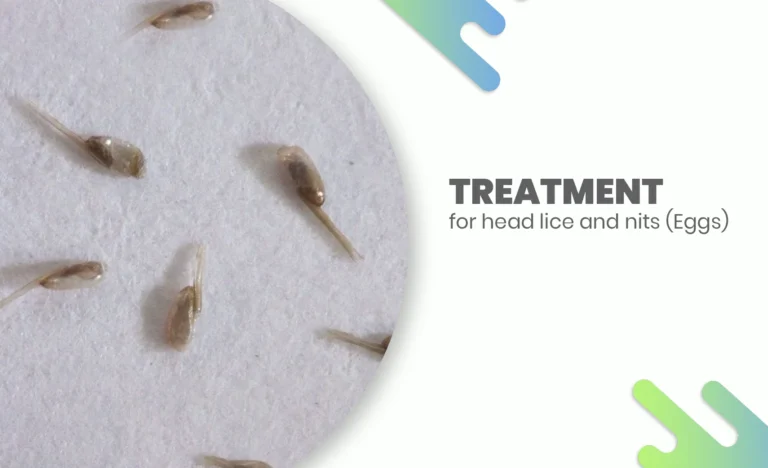 Head lice treatment showing nits (eggs) close-up for lice removal awareness.