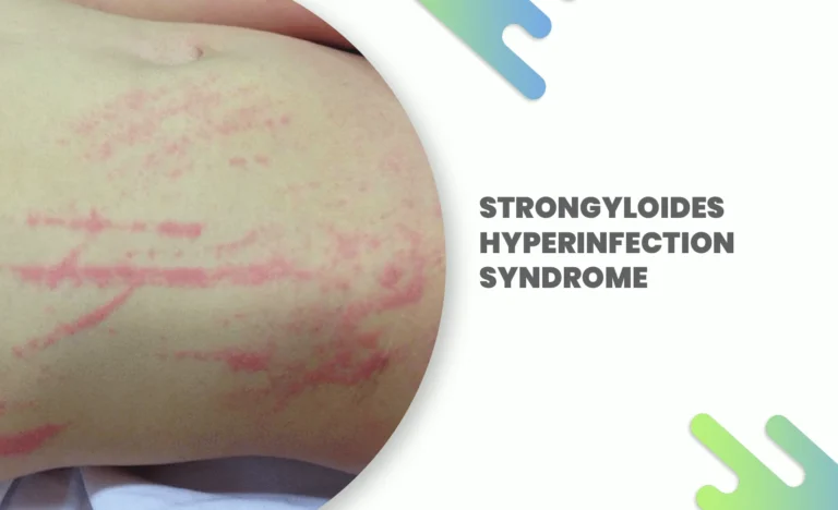 Strongyloides hyperinfection syndrome skin rash on abdomen