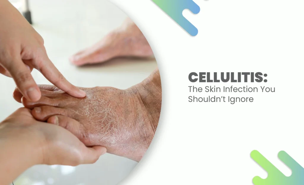 Hands examining a swollen, dry foot showing signs of cellulitis skin infection