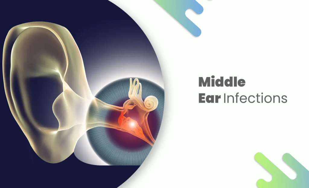 Illustration of middle ear infection showing inner ear anatomy.
