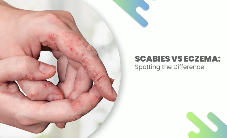 Itchy red skin caused by scabies vs eczema
