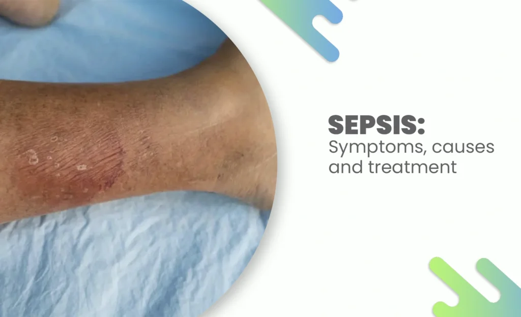 Sepsis symptoms on leg skin showing redness and inflammation.