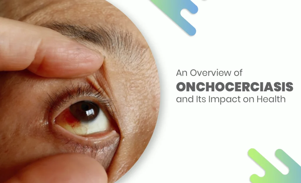 Close-up of an eye being examined, highlighting symptoms of Onchocerciasis (river blindness).