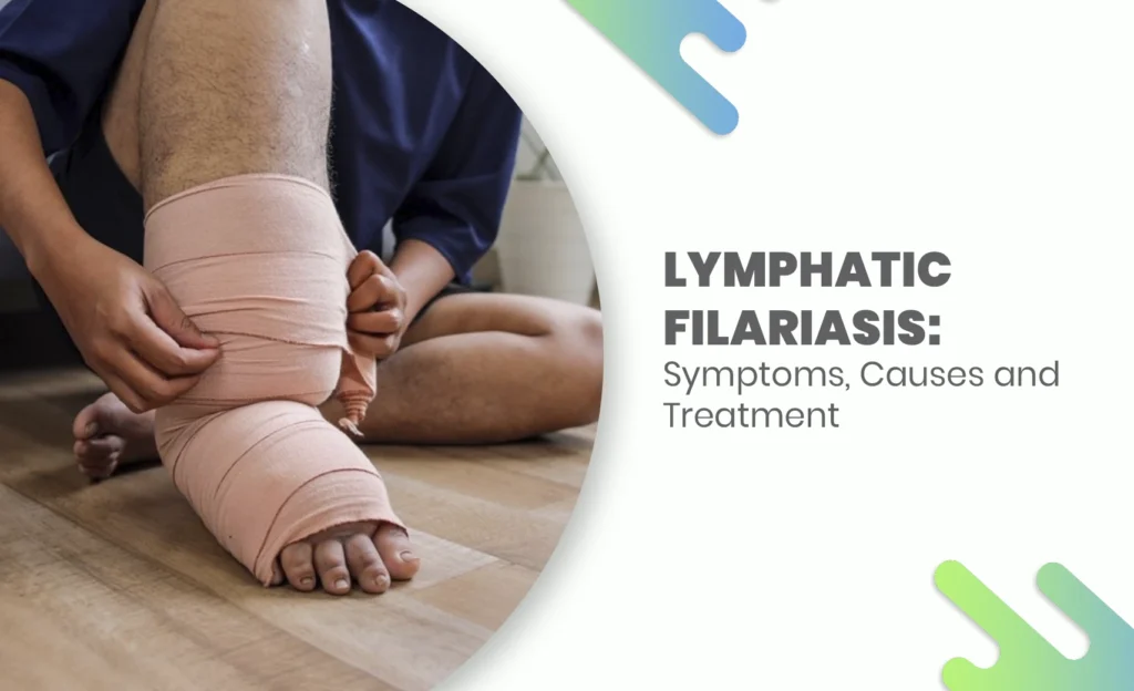 A person wrapping a swollen leg with a bandage, showing symptoms of lymphatic filariasis, a parasitic infection causing lymphedema.