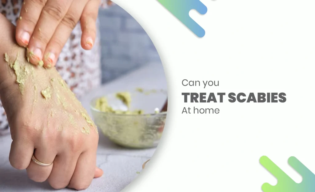 A person applying a natural paste on their hand as a home remedy for scabies, with a bowl of herbal mixture in the background and text saying "Treat Scabies at Home"