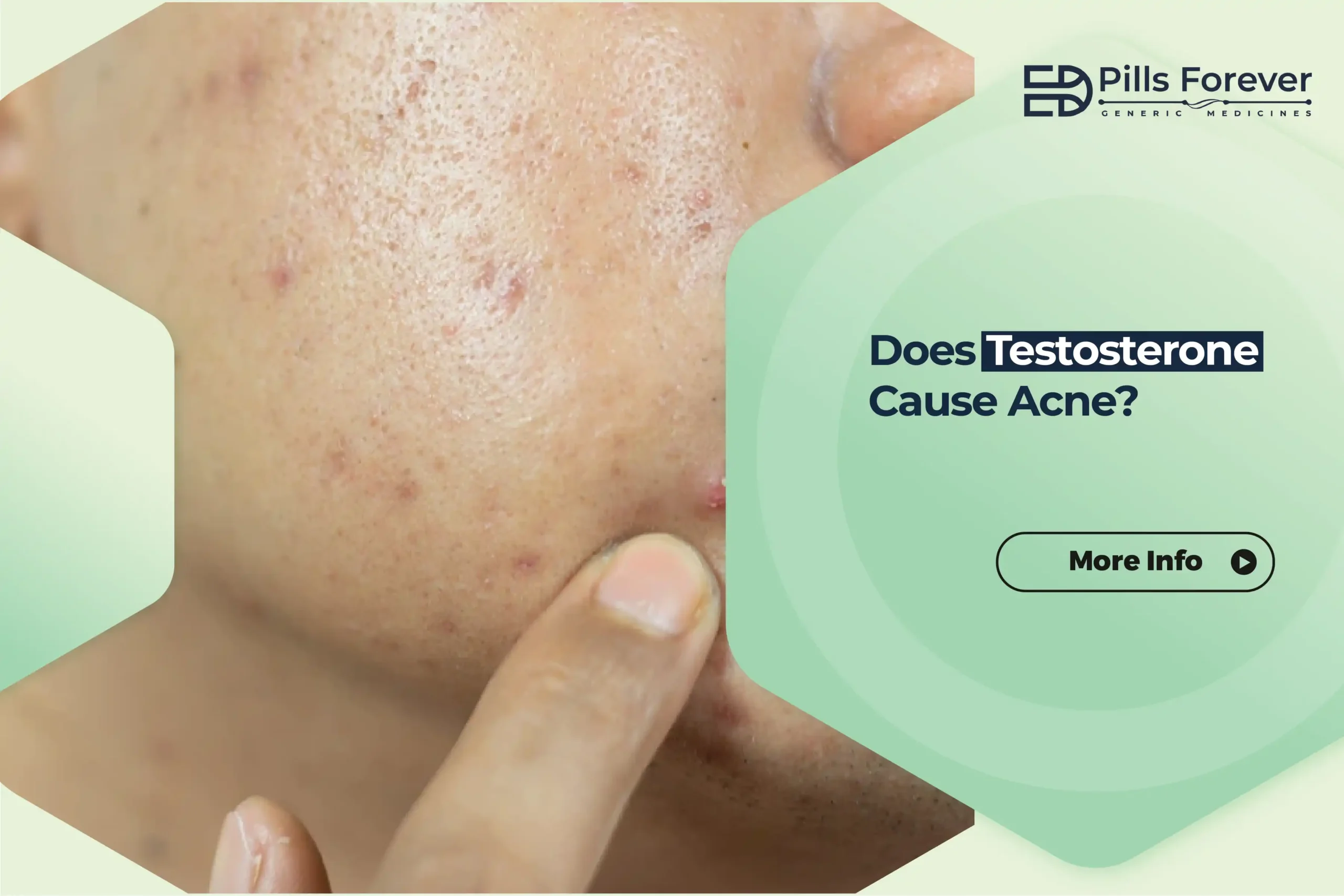 Does Testosterone Cause Acne