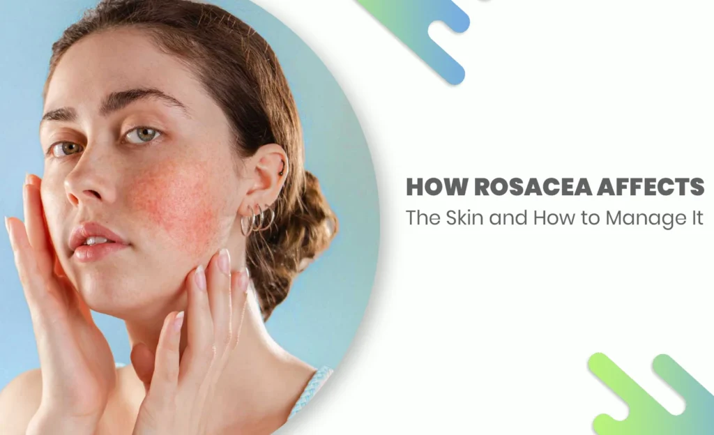 Woman with facial redness from rosacea touching her cheeks – rosacea symptoms and skin care management