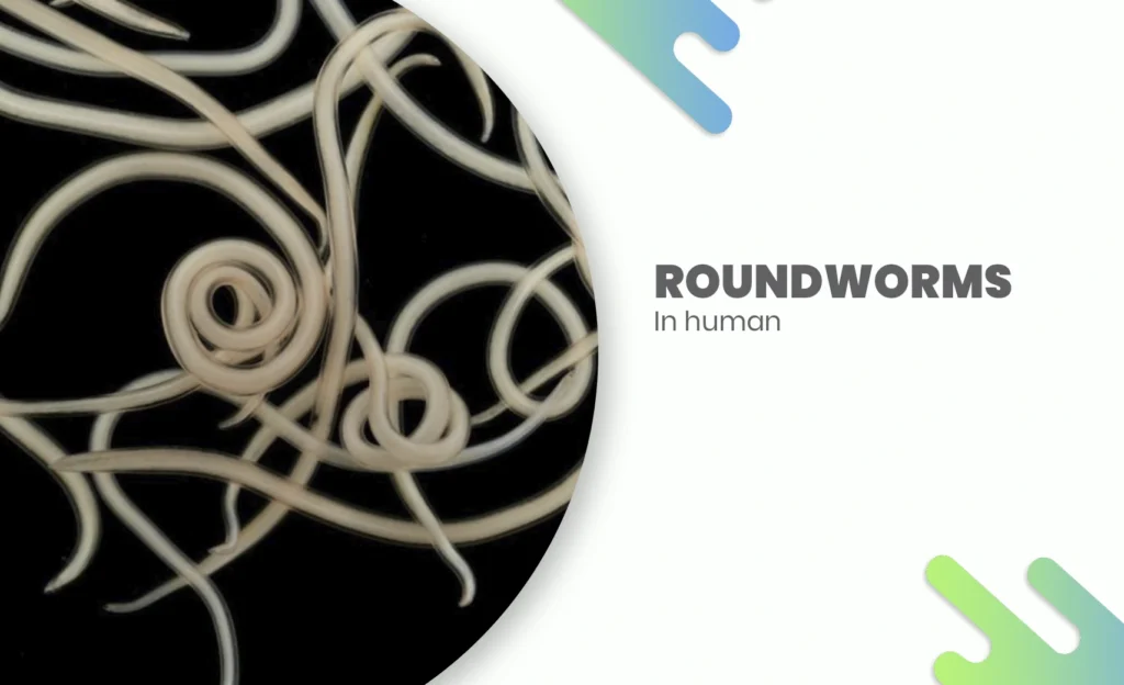 Roundworms in Humans – image showing intestinal roundworms (Ascaris lumbricoides) that infect the human body.