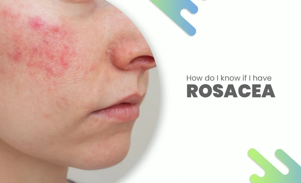 Close-up of cheek redness showing symptoms of rosacea.