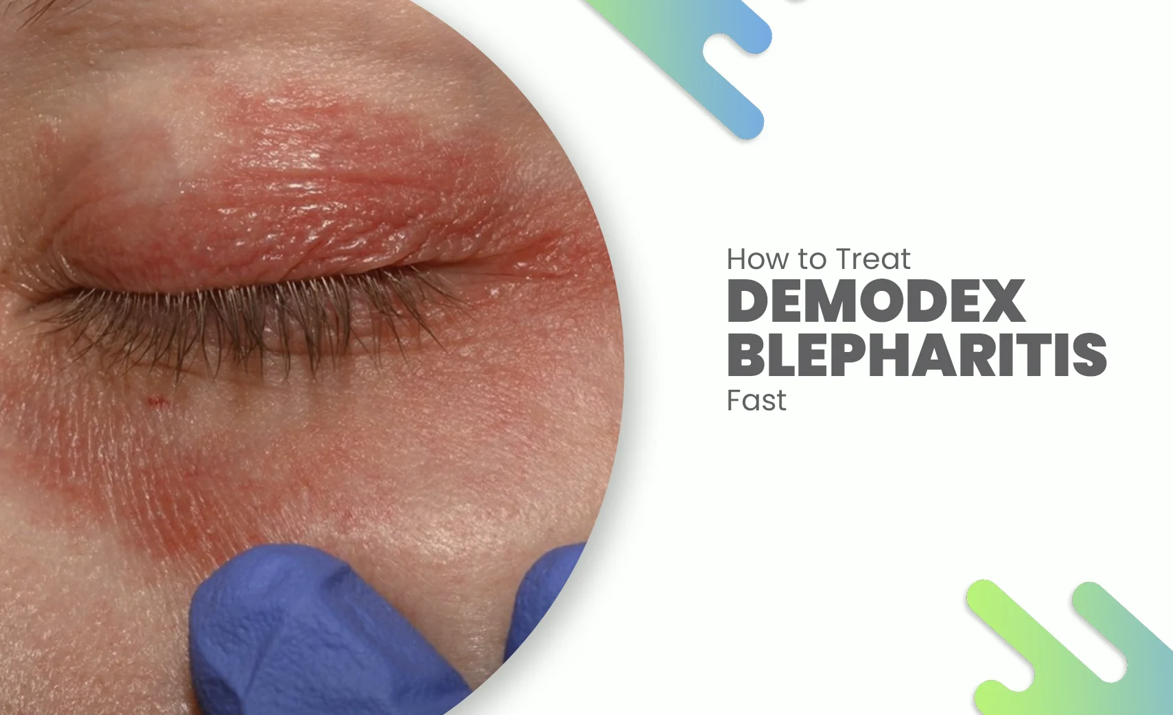 Close-up of red, inflamed eyelid showing symptoms of Demodex blepharitis.