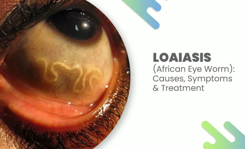Loiasis infection showing an African eye worm visible under the surface of the eye.