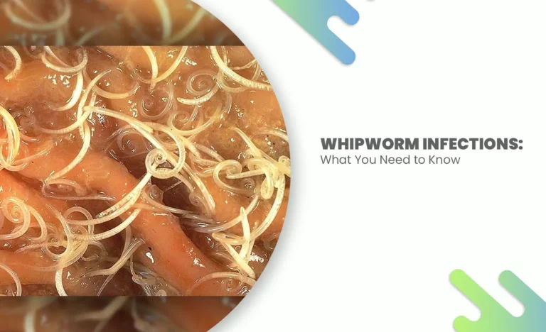 Microscopic image of a whipworm infections in the intestine.