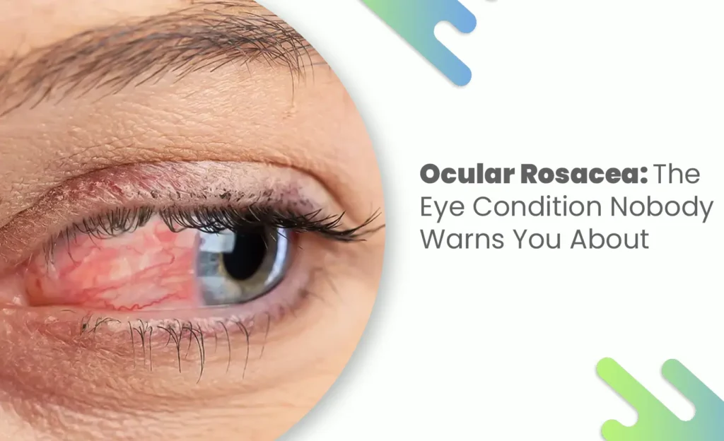 Severe ocular rosacea causing red, irritated eye