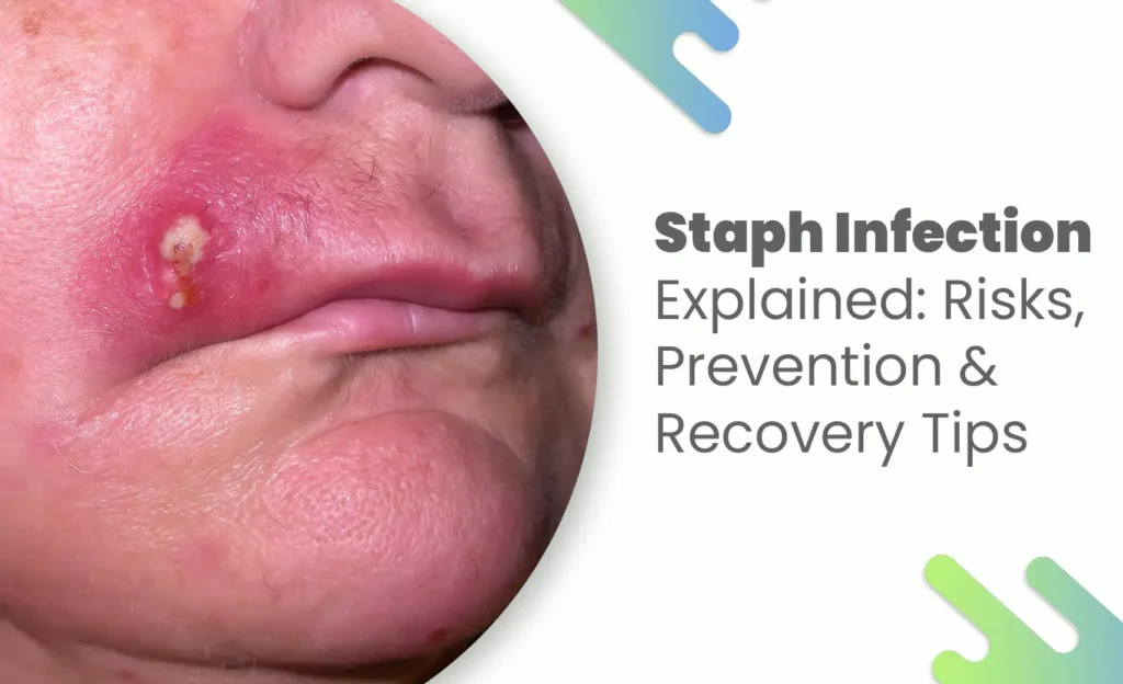 Staph infection on the face showing a red, swollen lesion with visible pus near the lip.