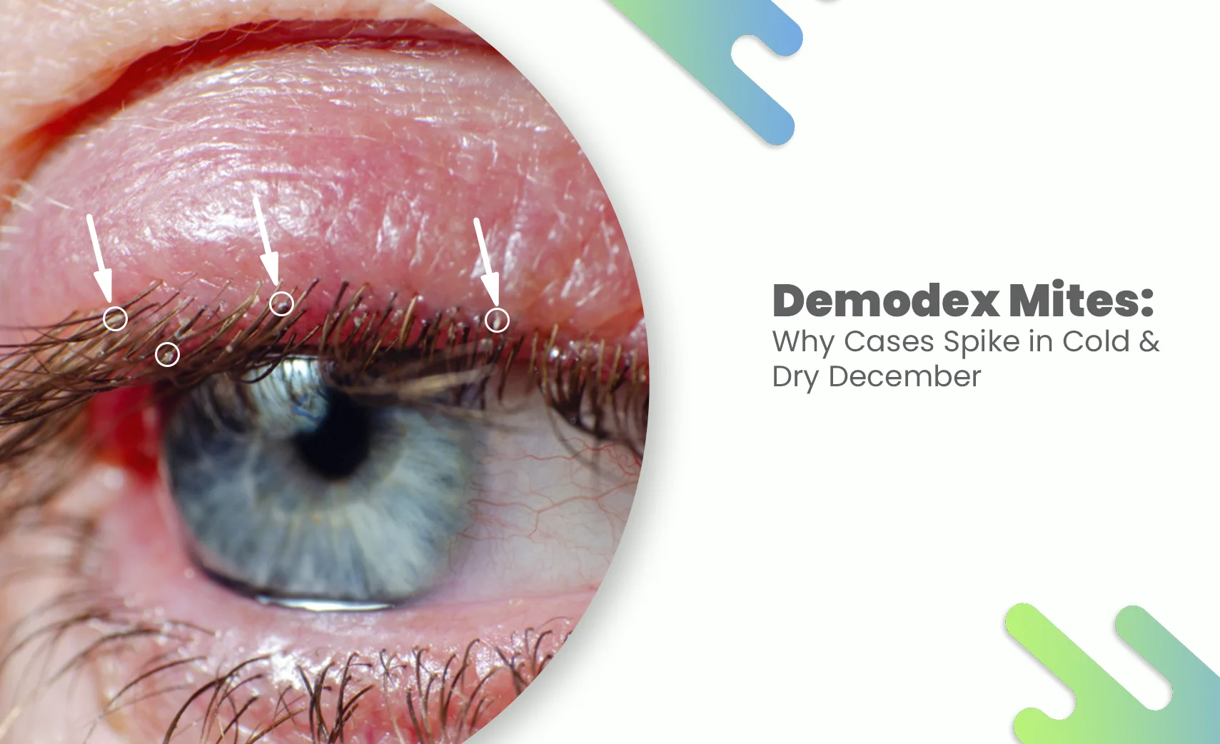 Demodex Mites affecting eyelash follicles in winter